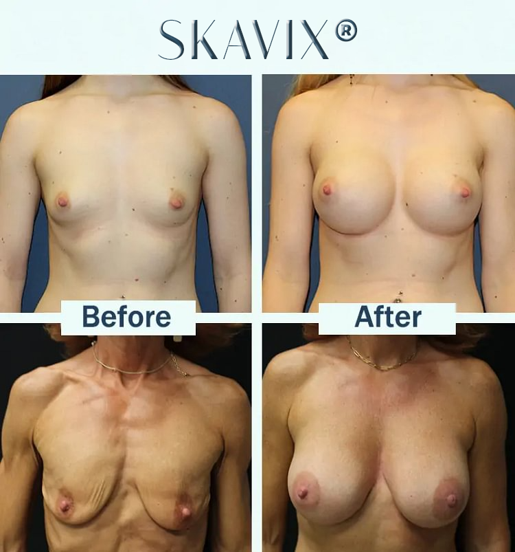 🔥Limited-time 60% sale--Skavix Targeted Breast Enhancement Advanced Nano-Microneedle Patches