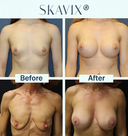 🔥Limited-time 60% sale--Skavix Targeted Breast Enhancement Advanced Nano-Microneedle Patches