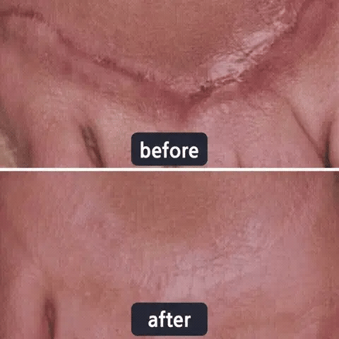 🔥Limited-time 60% sale--LOVILDS Scar Repair Cream — Smooth, Clear, Confident Skin